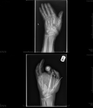 X-rays of Lelliott's hand before (top) and after the initial emergency surgery. Credit: St George’s University Hospitals NHS Foundation Trust