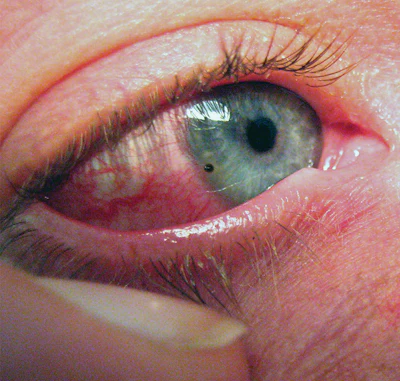 4 P 1219 Wfb Dj20 First Aid Foreign Body In Eye Med