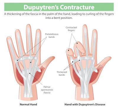 Dupuytrens Contracture Shutterstock 2473784461 Copy