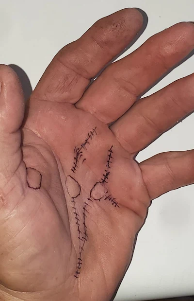 Stiches After Dupuytren Surgery
