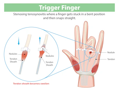 Trigger Finger Shutterstock 2473784537 Copy