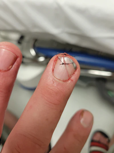 Finger with surgical stitches on nail bed in medical setting with equipment visible